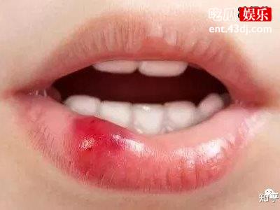 得了唇炎怎么办？教你快速缓解