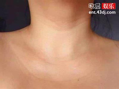 淡化颈纹你也能年轻好多岁，淡化颈纹有什么好处？