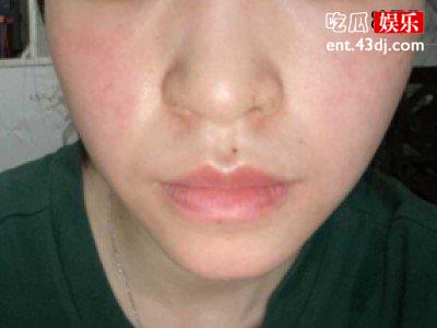 脸部红潮怎么祛除，丽绯特舒适肌肤打造充满活力透明肌肤