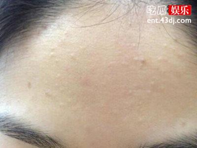 闭口问题怎么办？刷酸是个好主意