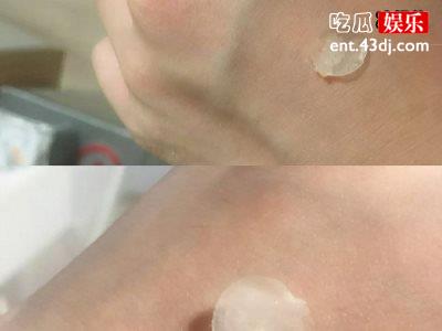 水胶体痘痘贴的龙头企业“尼科美缔可”