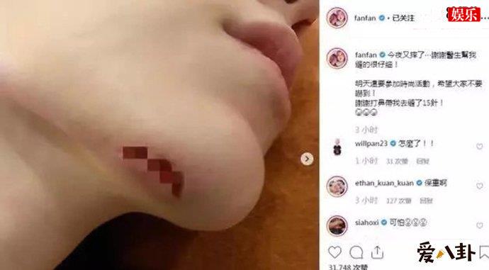 范玮琪下巴缝15针