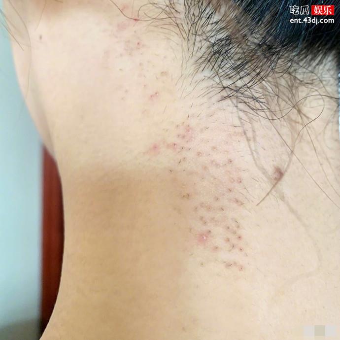 杨紫毛孔发炎照片