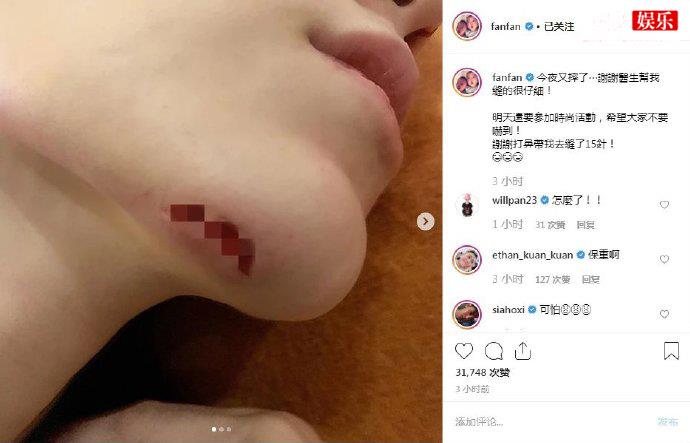 范玮琪下巴摔伤